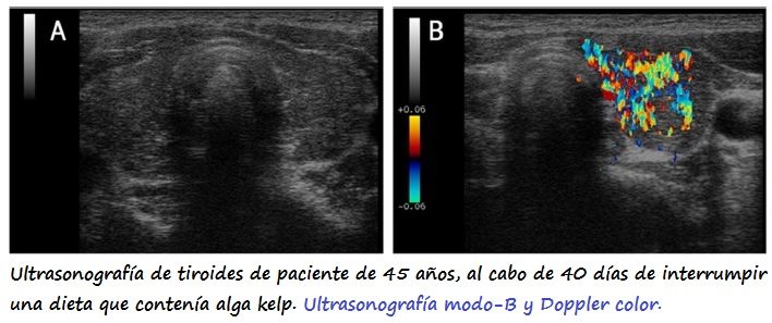 Izda: Ultrasonografía modo-B. Drcha: Doppler color